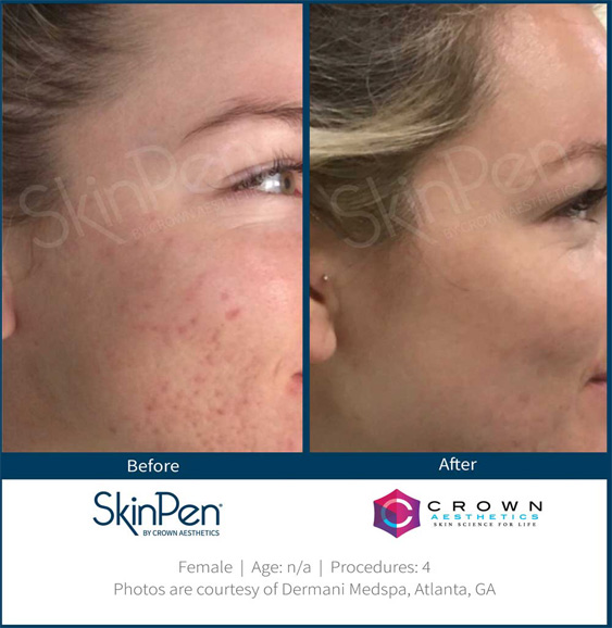 Stunning-Results--SkinPen-SkinPen-Microneedling-Sarasota-Medical-Spa